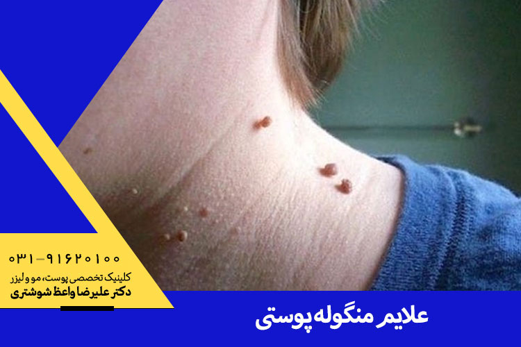 منگوله‌ی پوستی چیست و چگونه درمان میشود؟ | دکتر علیرضا واعظ شوشتری متخصص پوست در اصفهان