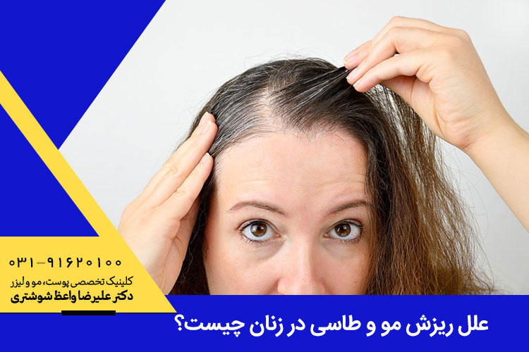 علت ریزش مو و طاسی در زنان چیست