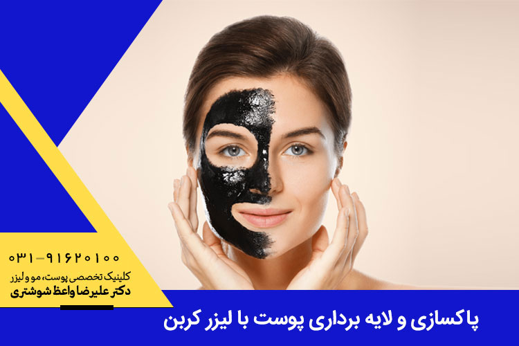 پاکسازی و لایه برداری پوست با لیزر کربن