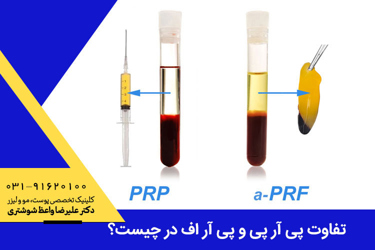 تزریق پی آر اف در اصفهان