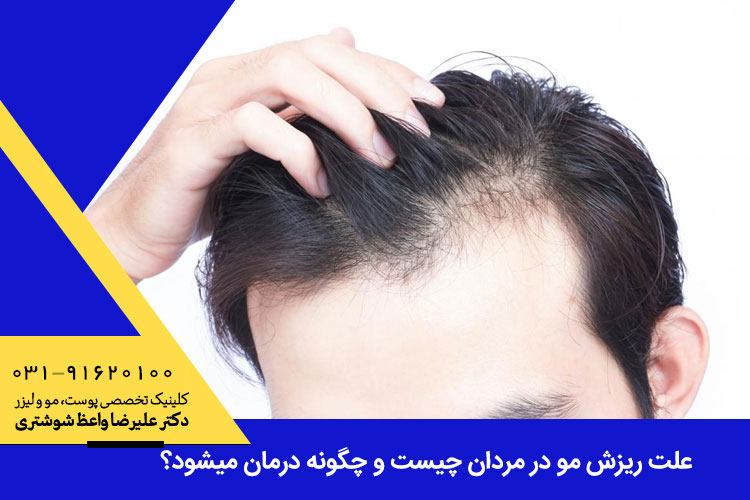 علت ریزش مو در مردان