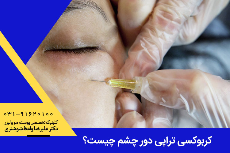 کربوکسی تراپی دور چشم