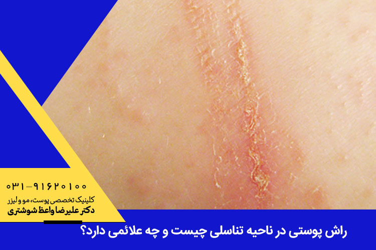 راش پوستی در ناحیه تناسلی