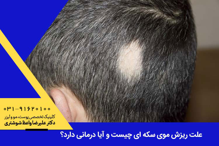 علت ریزش موی سکه ای