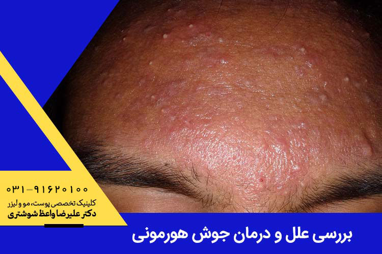 بررسی علل و درمان جوش هورمونی