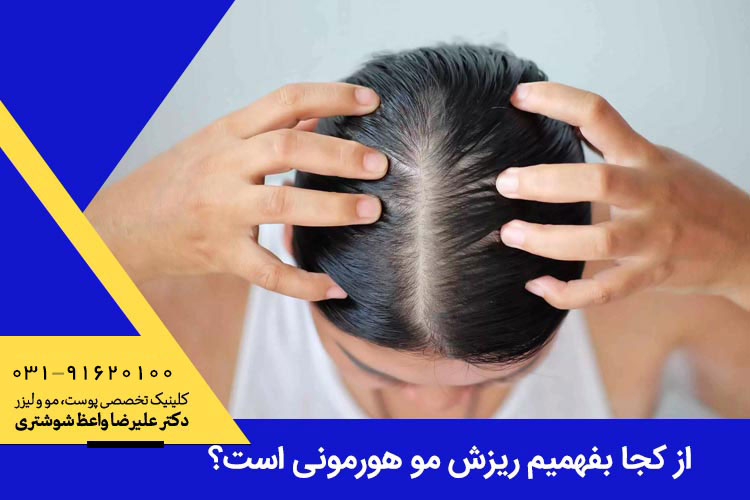 ریزش مو هورمونی