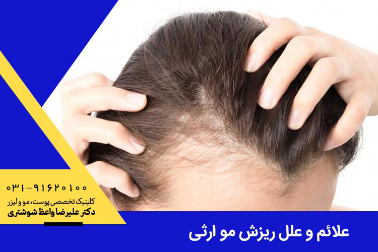 علائم و علل ریزش مو ارثی