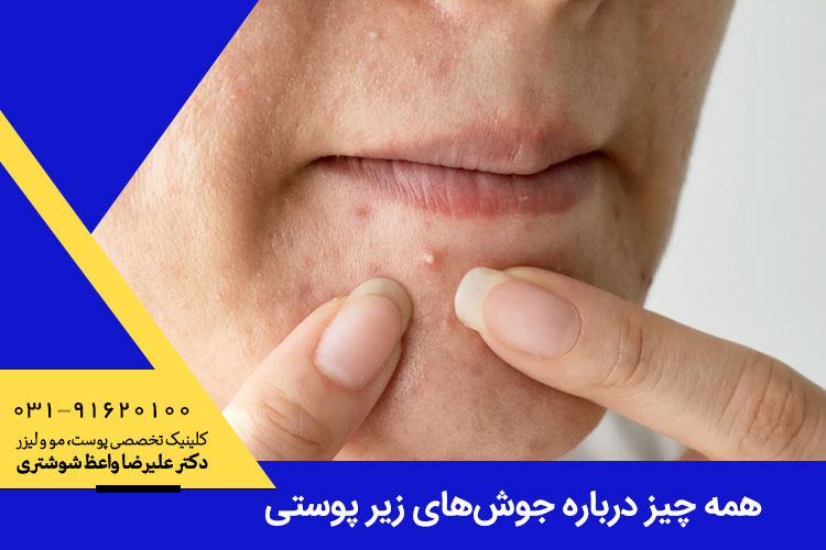 جوش های زیر پوستی