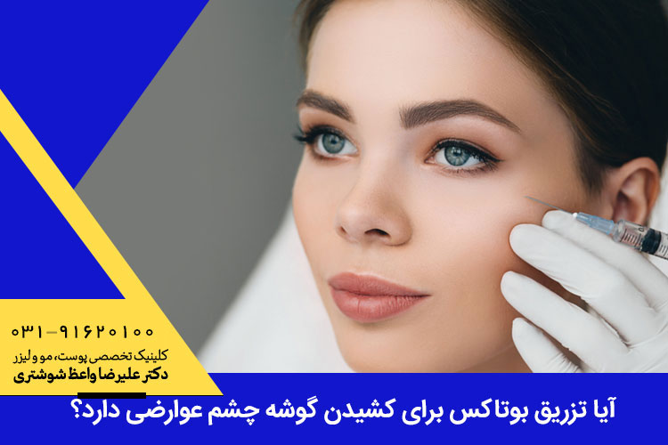 تزریق بوتاکس برای کشیدن گوشه چشم