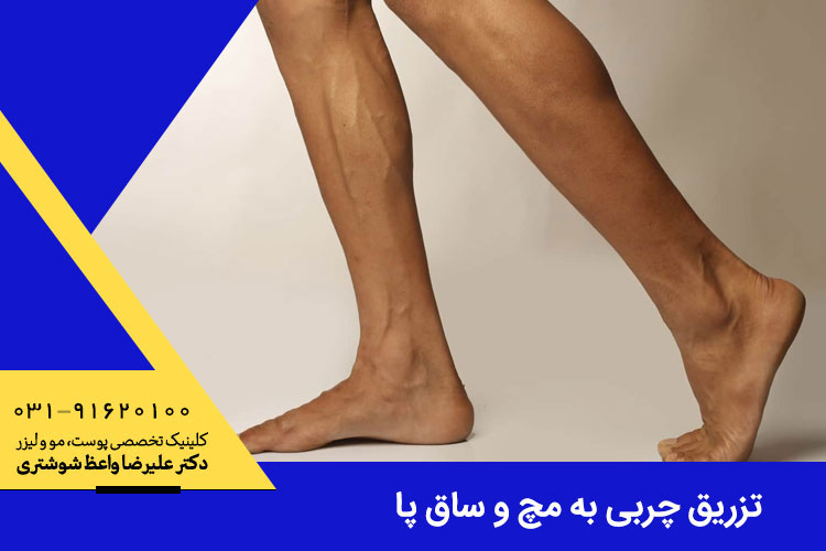 تزریق چربی به مچ و ساق پا