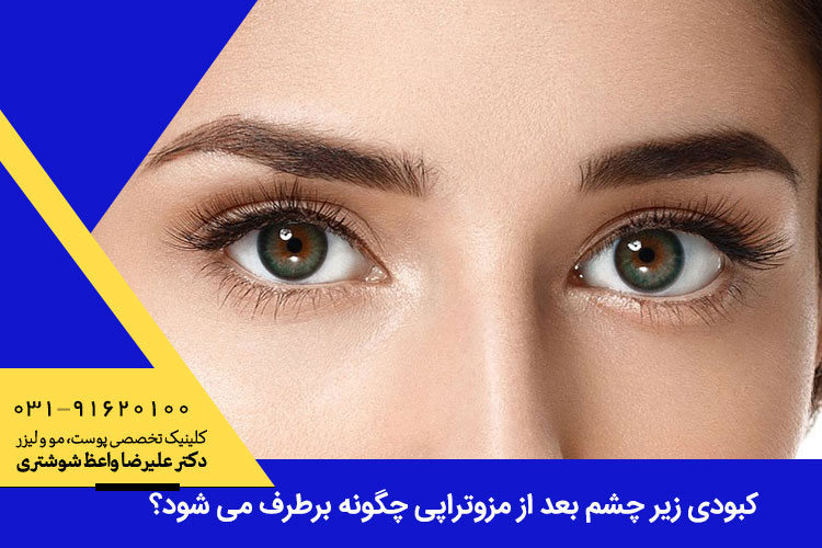 کبودی زیر چشم بعد از مزوتراپی