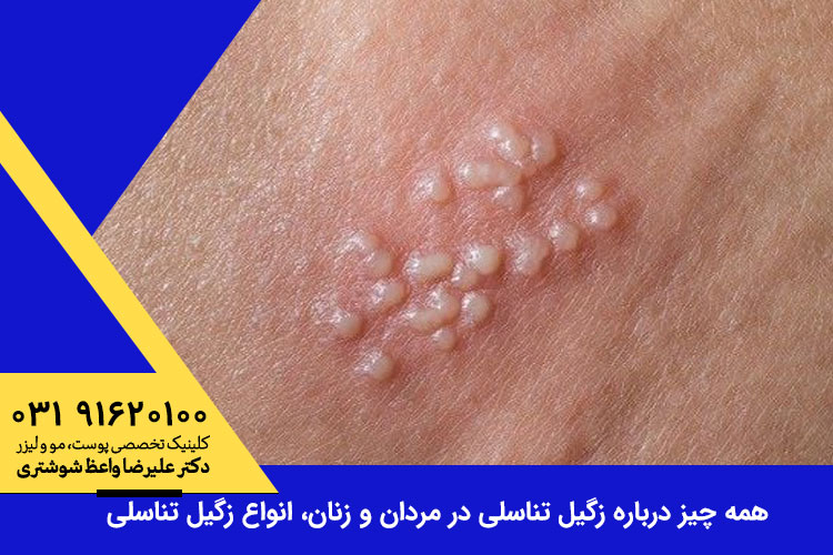 انواع زگیلی تناسلی 