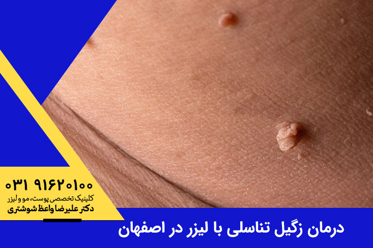 لیزر زگیل تناسلی