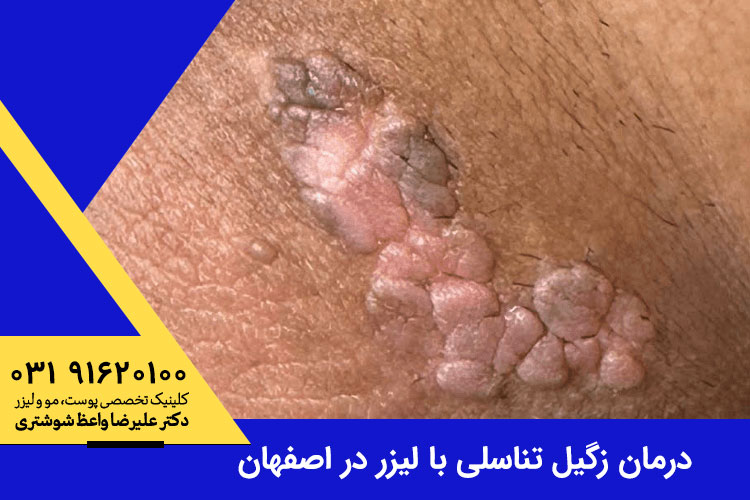 درمان زگیل تناسلی با لیزر در اصفهان