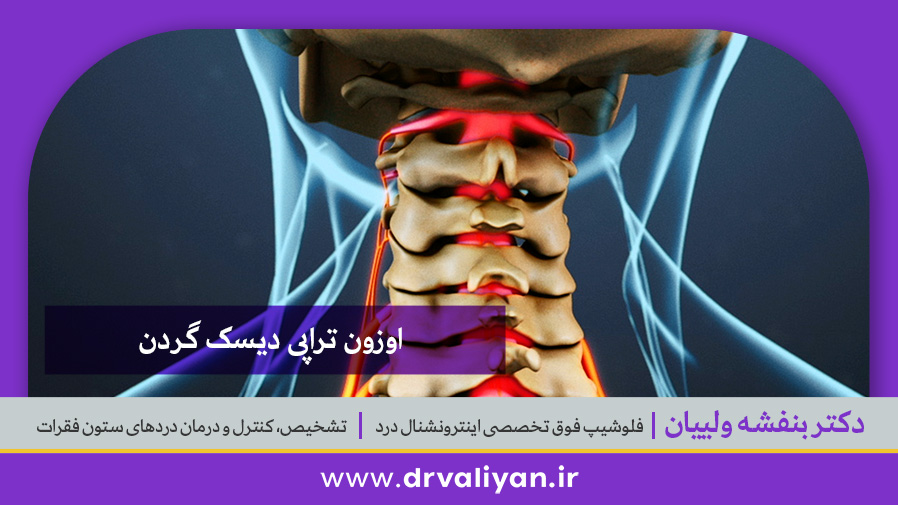 دیسک گردن