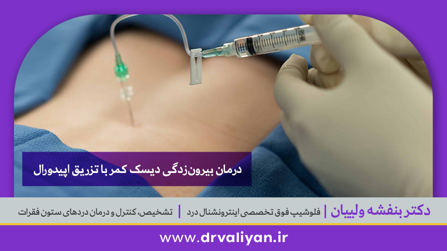 درمان بیرونزدگی دیسک کمر