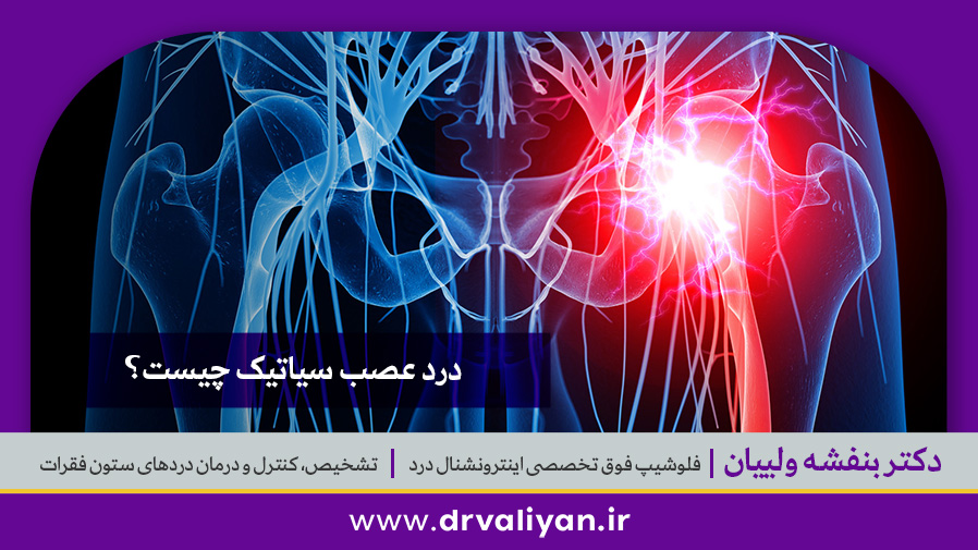 درد عصب سیاتیک