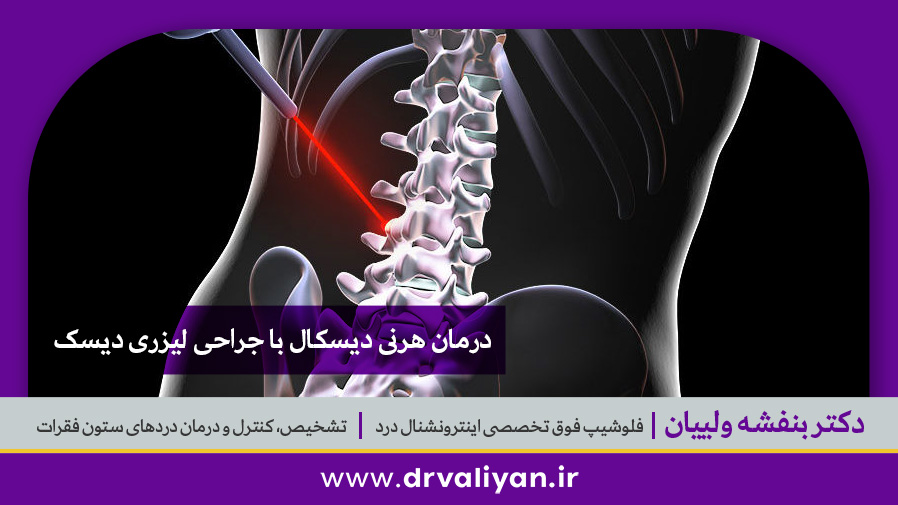 درمان هرنی دیسکال با جراحی لیزری دیسک