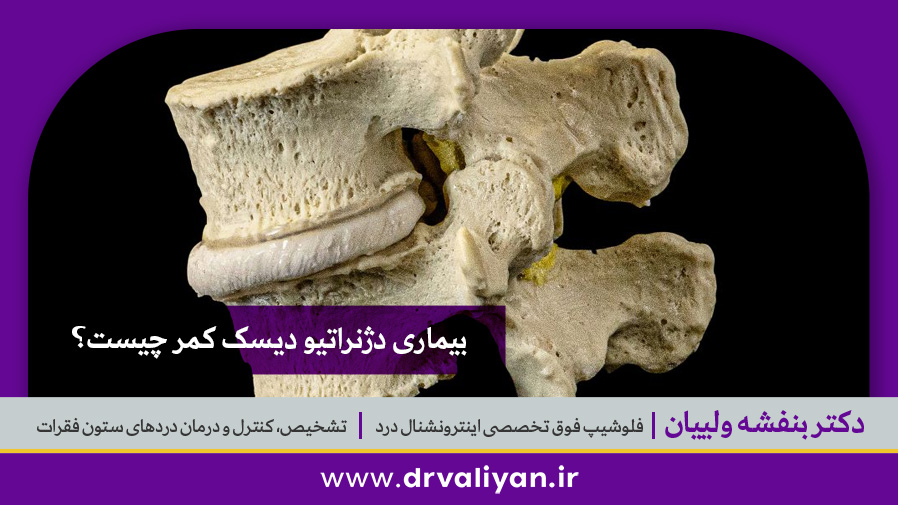 بیماری دژنراتیو دیسک کمر