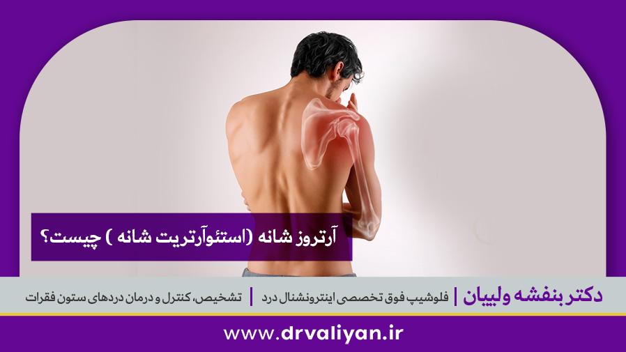 آرتروز شانه