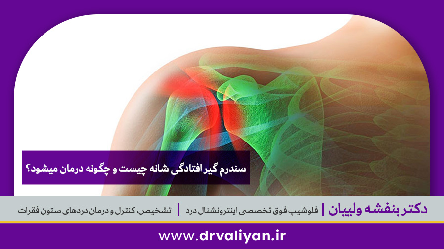 سندرم گیرافتادگی شانه