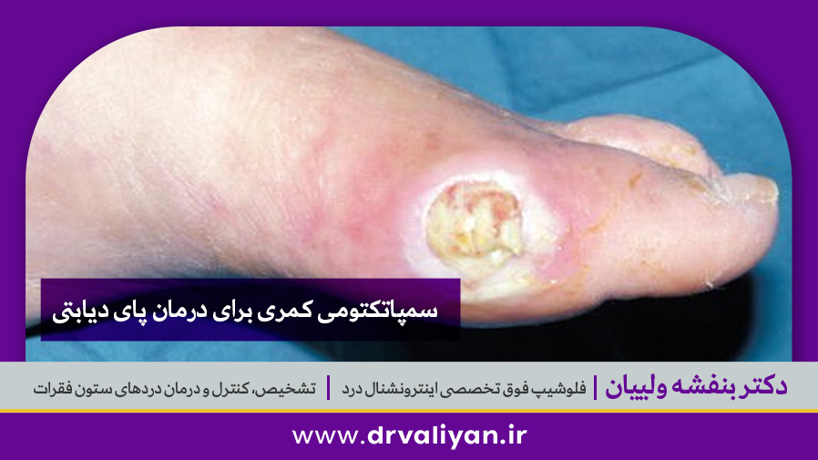 سمپاتکتومی کمری برای درمان پای دیابتی