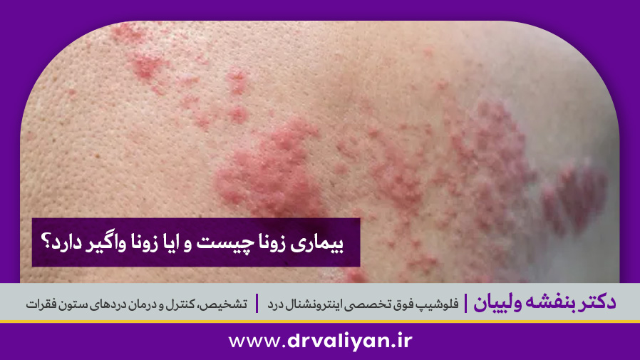 بیماری زونا