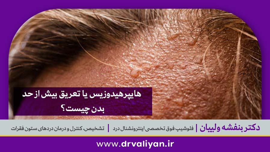 هایپرهیدوزیس یا تعریق بیش از حد بدن