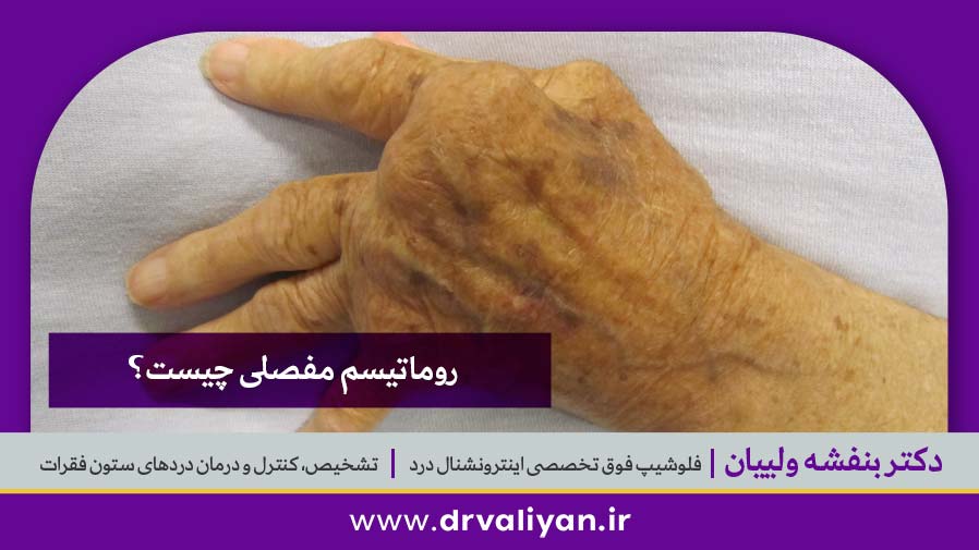 روماتیسم