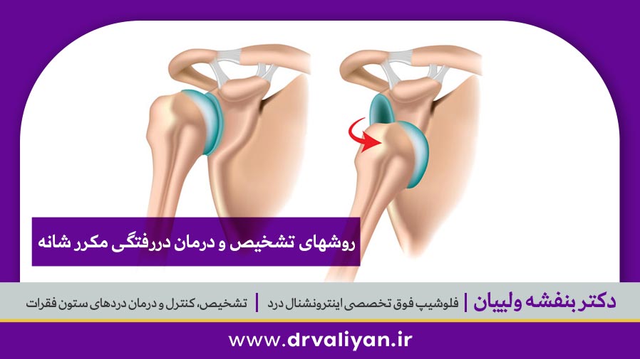 درمان دررفتگی مکرر شانه