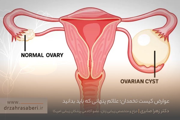 عوارض کیست تخمدان چیست