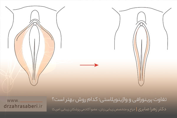 واژینوپلاستی و پرینورافی 