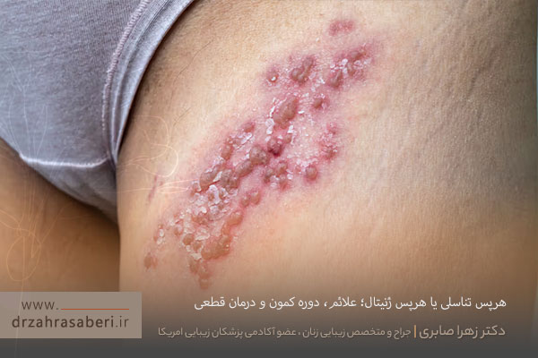هرپس تناسلی