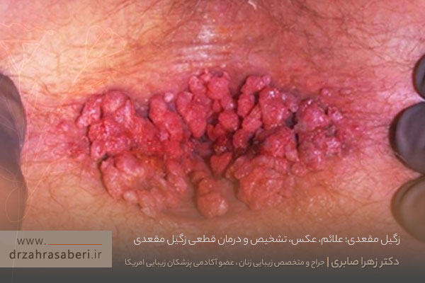 زگیل مقعدی چیست