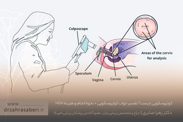 کولپوسکوپی