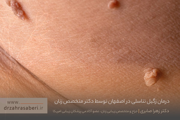درمان زگیل تناسلی