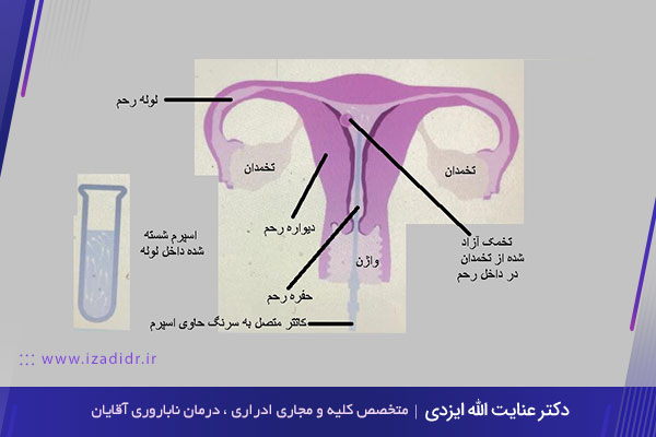 تلقیح اسپرم اهدایی 