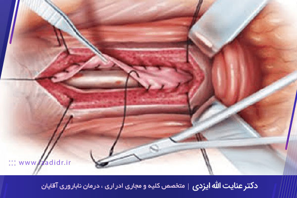 درمان کجی آلت تناسلی