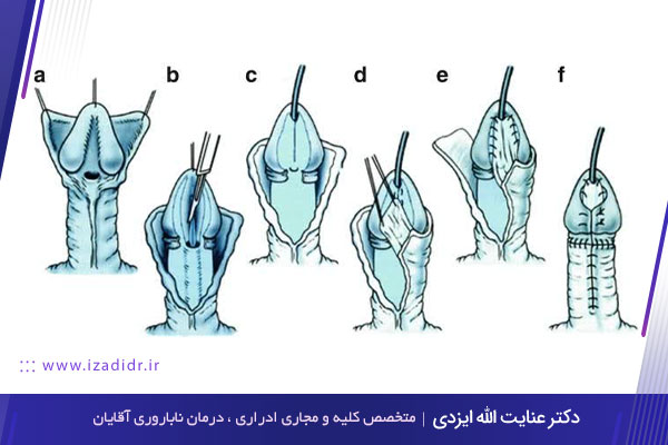 کجی آلت تناسلی