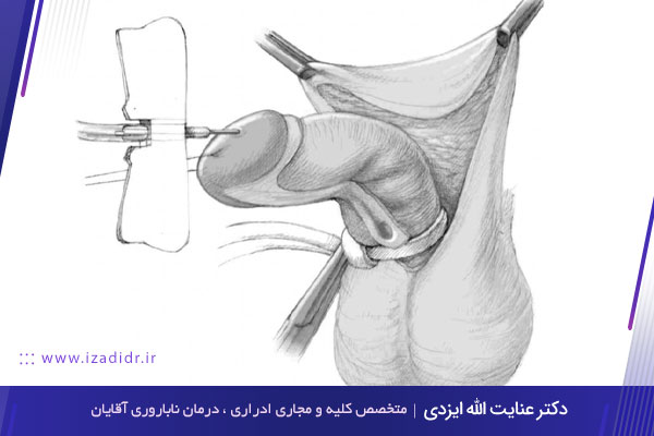 کجی آلت تناسلی