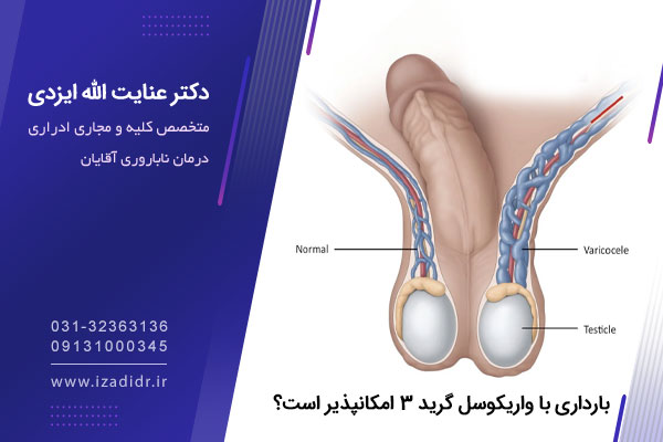واریکوسل گرید 3 چیست؟