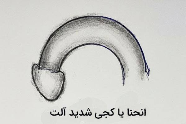 کجی آلت تناسلی
