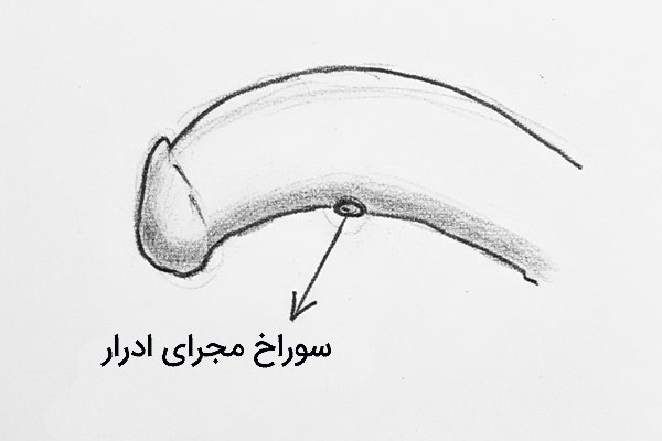 غیر طبیعی بودن محل سوراخ ادرار