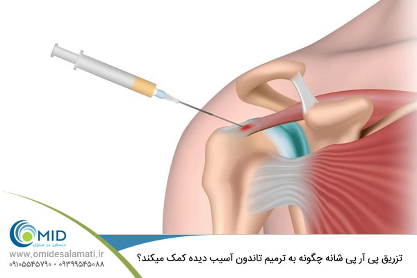 تزریق پی آر پی شانه