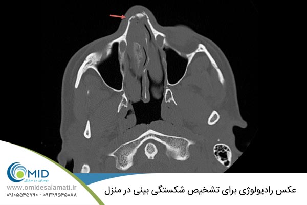 رادیوگرافی شکستگی بینی