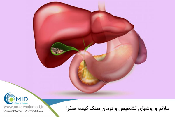  درمان سنگ کیسه صفرا