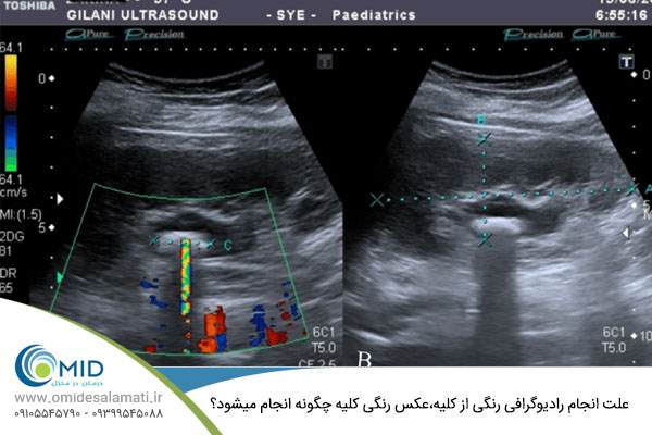 علت انجام رادیوگرافی رنگی از کلیه