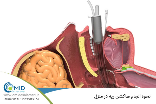 ساکشن ریه در منزل