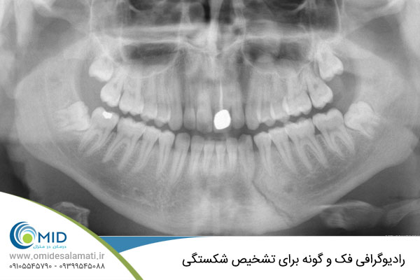 رادیوگرافی فک و گونه برای تشخیص شکستگی