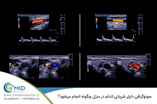 سونوگرافی داپلر وریدی